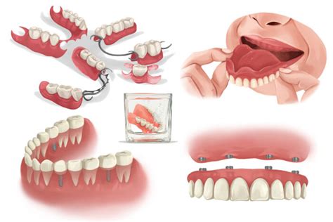 Dentures Vs Dental Implants Premier Dental Implant Studio Estero FL