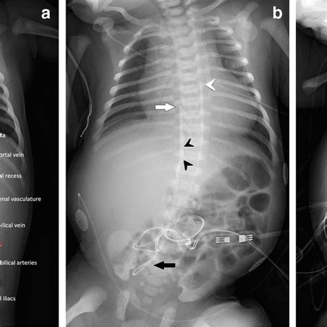 Malpositioned Umbilical Venous Catheter Uvc In A 6 Day Old Girl Download Scientific Diagram