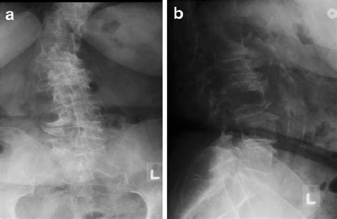 A B Antero Posterior And Lateral Radiographs Of Degenerative Lumbar