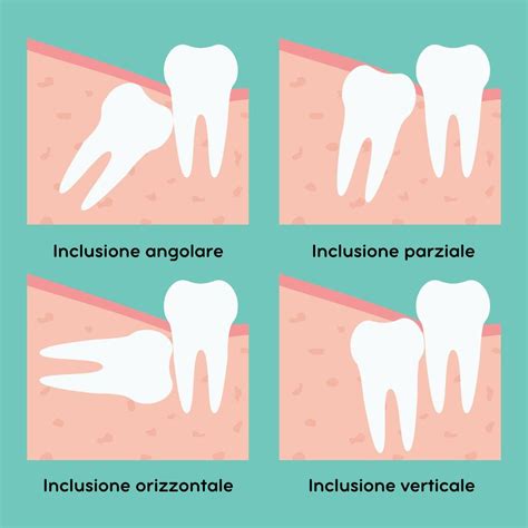 I Denti Del Giudizio Inclusi Cause Sintomi Trattamento Smile Studio