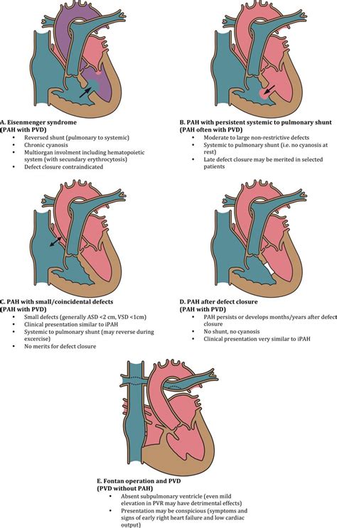 Pulmonary Arterial Hypertension In Adult Congenital Heart Disease Heart