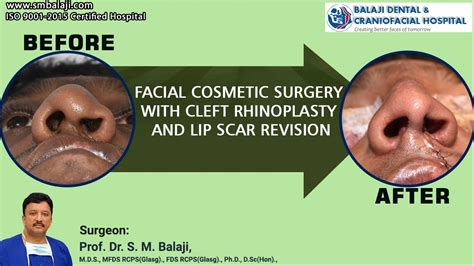 Facial Cosmetic Surgery With Cleft Rhinoplasty And Lip Scar Revision