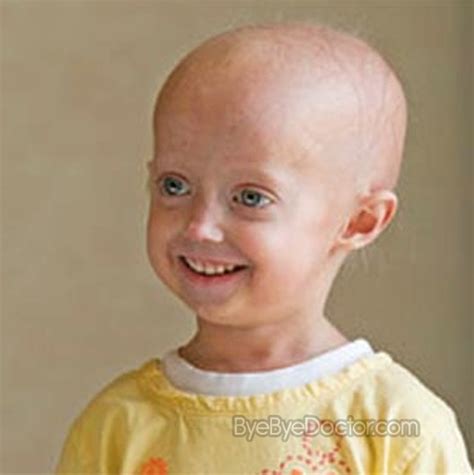 Progeria Pictures Symptoms Causes Treatment Diagnosis