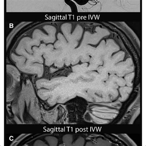 Reversible Cerebral Vasoconstriction Syndrome With Associated Download Scientific Diagram