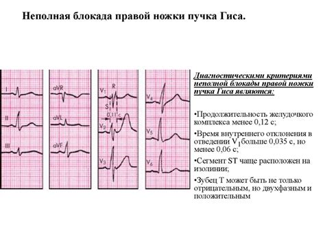Признаки блокады ножек пучка гиса на ЭКГ - презентация онлайн