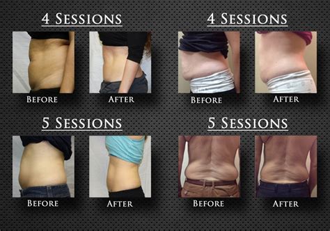 Hollywood Body Wraps – Lipo Laser