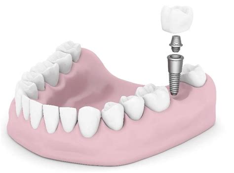 Dental Implants Evansville In 5 Facts About Dental Implants