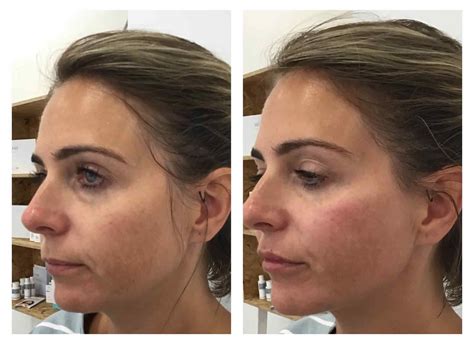 Face Contouring In Leeds Dermal Fillers Face Perfect Clinic