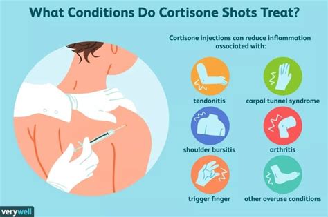 Cortisone Injections Vs Posture Therapy Posture First Exercise Therapy