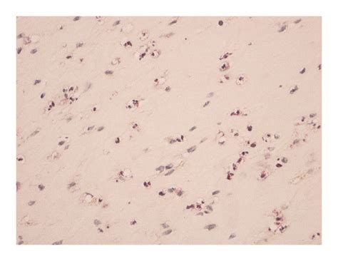 Frozen Section Of Inflammatory Tissue Showing Chloroacetate Esterase