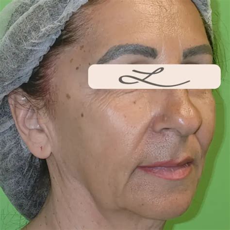 Lifting Facial Chirurgical Gât și Sprâncene Dr Lazar