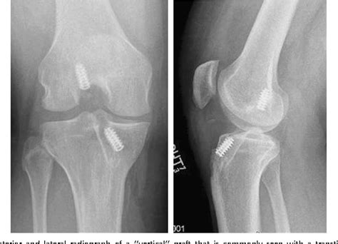 Figure 1 from Anatomic revision ACL reconstruction. | Semantic Scholar