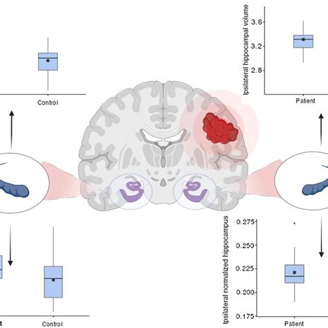 The Effect Of Glioma On The Hippocampal Volume Box Plots Showing Both Download Scientific