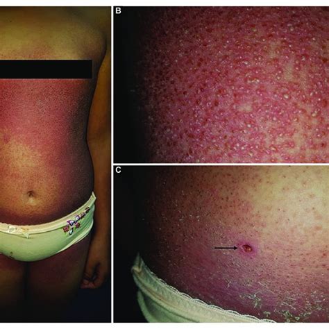 Acute Generalized Exanthematous Pustulosis Subcorneal Blister In The