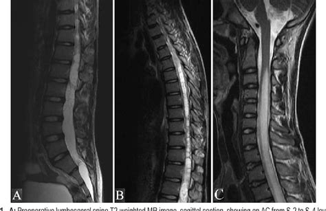 Figure 1 From A Sacral Arachnoid Cyst Causing Holocord Syringomyelia