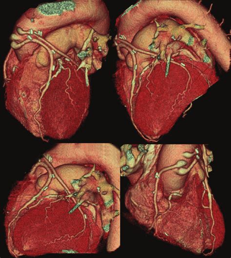 Slice Cardiac Ct With Multiple D Reconstructions Patent Grafts To