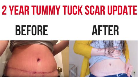 2 Year Tummy Tuck Scar Update Vlogmas Day 11 Youtube