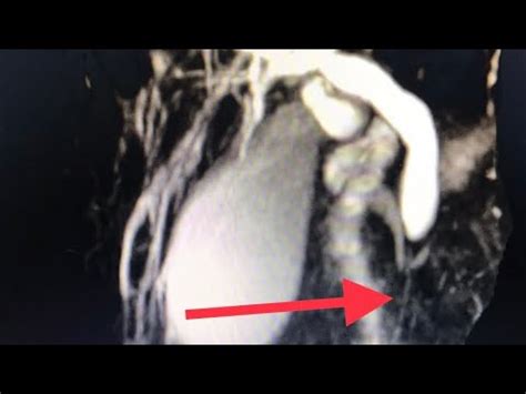 Cedifi Cper E Ecoendoscopia No Diagn Stico De C Ncer De P Ncreas