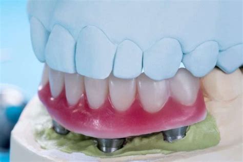 Premier Dental Implants In Tampa Tampa Implant Clinic