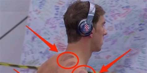 Olympian Michael Phelps has circle marks from cupping therapy: Benefits - Business Insider