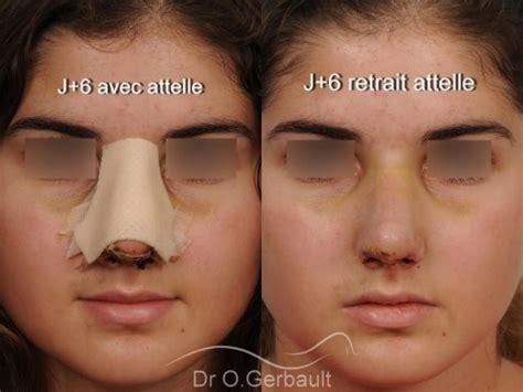 Rhinoplastie avant après photos et exemples de nez refaits