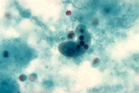 10 Amebiasis Entamoeba Histolytica Free Images