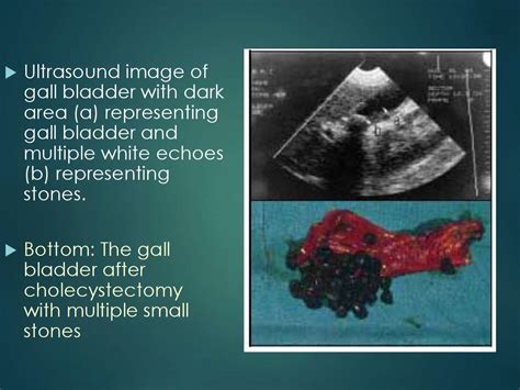 Chronic Cholecystitis As Related To Inflammation Pictures