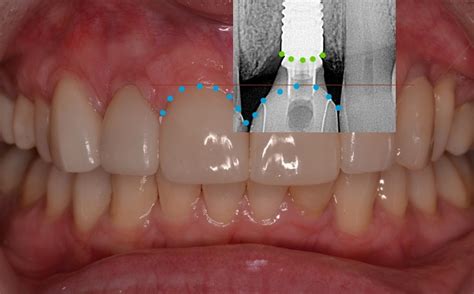 Anterior Implant Placement And The 3 2 Rule RENSTROM DENTAL STUDIO INC