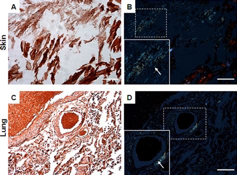 Congo Red Staining In Post Mortem Tissues From A Patient Diagnosed With