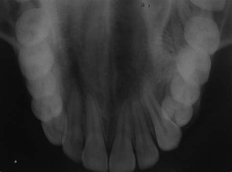 Maxillary Cross Sectional Occlusal Radiograph Showing Cortical Plates Download Scientific