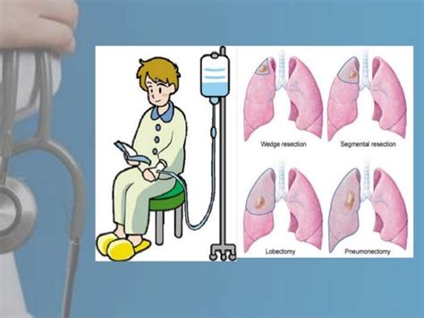 Chemotherapy At Different Stages Of Lung Cancer