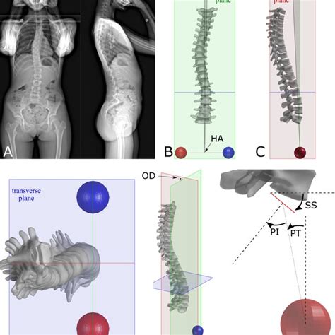 Biplanar Radiographs Of An Adolescent Idiopathic Scoliotic Patient A Download Scientific