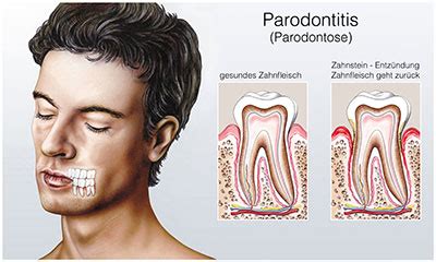 Parodontose Ursachen Und Behandlung Ursachen Symptome Behandlung