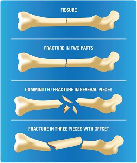 Types Of Complete Fractures