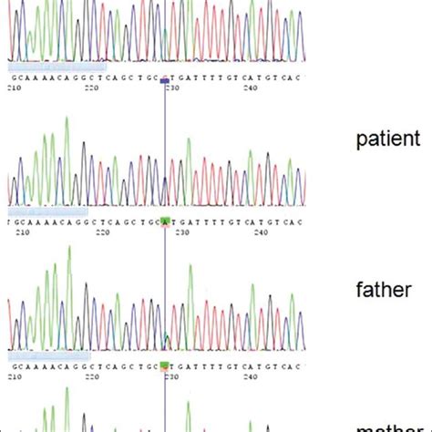 Sequence chromatograph showing a novel homozygous mutation (3593-A > G)... | Download Scientific ...