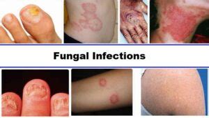 Understanding Common Fungal Infections A Comprehensive Guide Revitalis