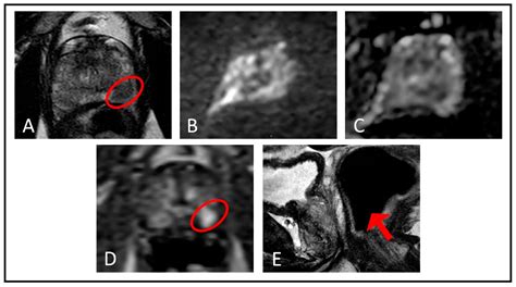 Life Free Full Text Current Status Of Biparametric Mri In Prostate Cancer Diagnosis