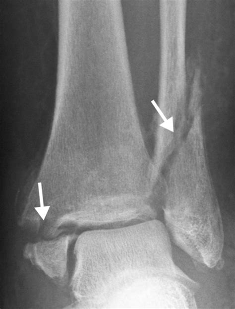 Xray Of Broken Ankle