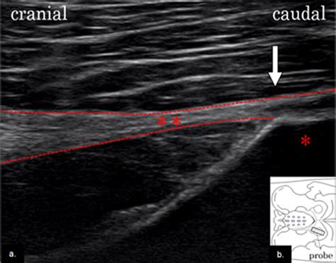 Identification of the sacrotuberous ligament. The sactorubetous... | Download Scientific Diagram