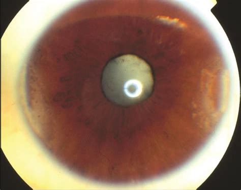 Types Of Cataracts The Cataract Course