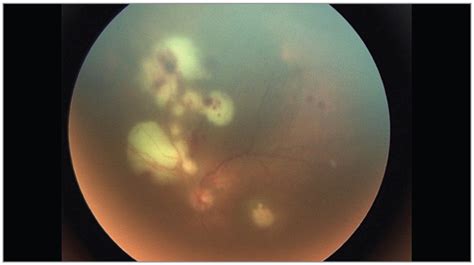 White Retinal Lesions In A Patient With Leukemia Hematology Jama Ophthalmology Jama Network