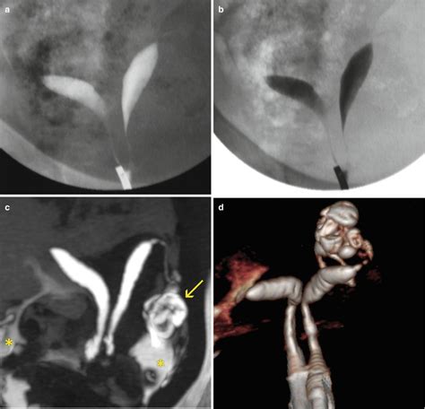 Uterine Septum Hsg