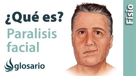 Par Lisis Facial Qu Es Youtube