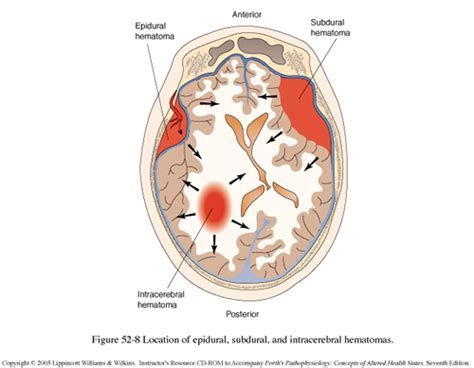 Traumatic Brain Injury Lillian S Wells Department Of Neurosurgery At