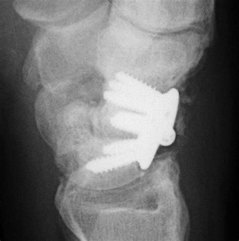 Four Corner Arthrodesis Using A Circular Plate And Distal Radius Bone