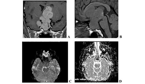 Mri Study Of The Sella Shows A Large Sellar Mass With Supra Sellar And