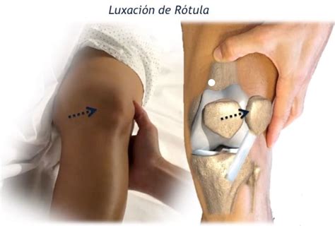 Luxaci N De R Tula En La Rodilla Causas S Ntomas Y Tratamiento