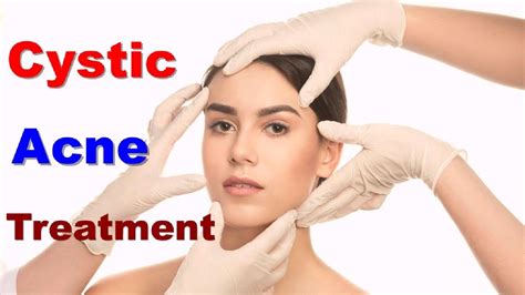 How To Cystic Acne Treatment Cystic Acne Treatment And Pimples