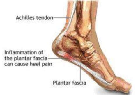 How To Avoid Plantar Fasciitis One Of The Most Common Runner Injuries