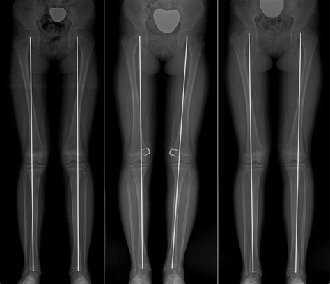 Prediction Of Rebound Phenomenon After Removal Of Hemiepiphyseal